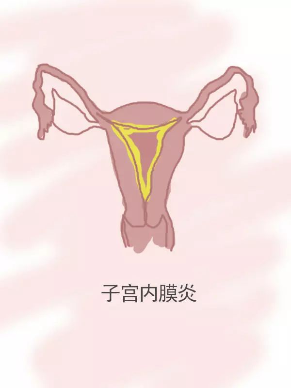 子宫内膜炎的症状图片
