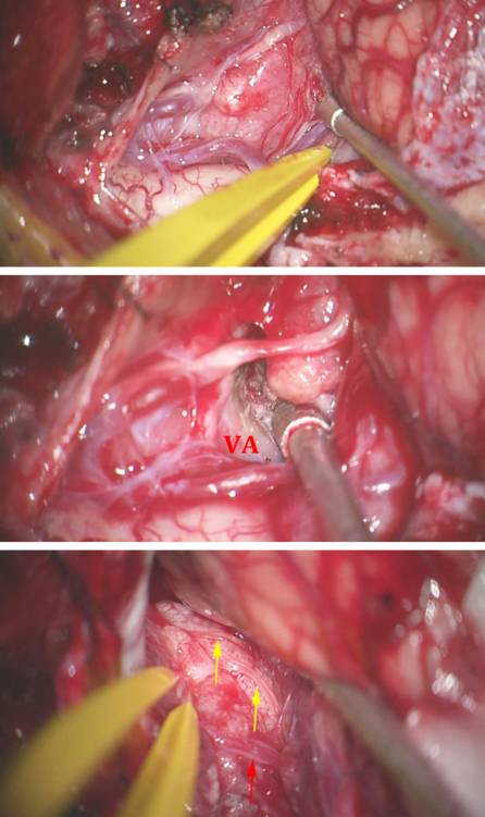 枕骨大孔區腦膜瘤的手術策略與技巧theneurosurgicalatlas全文翻譯