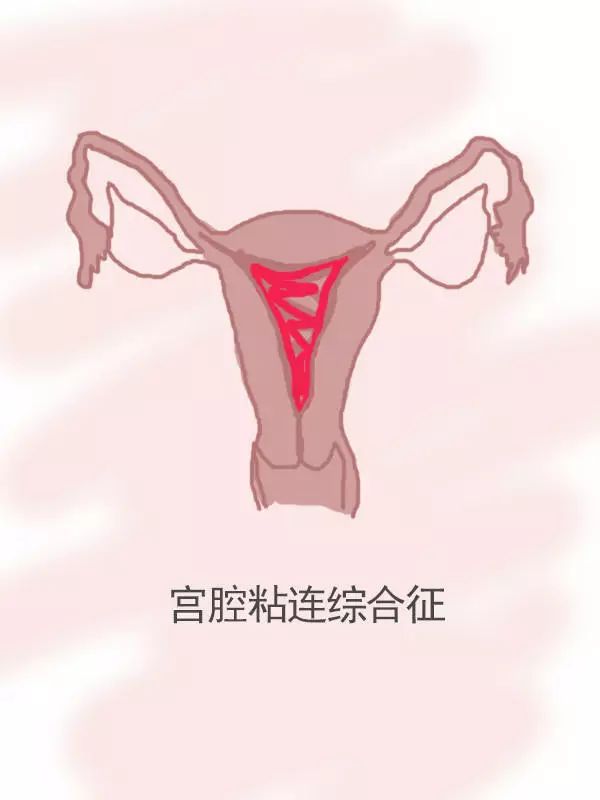 宫腔粘连综合征宫腔粘连综合征是指子宫内壁粘连造成宫腔全部或部分