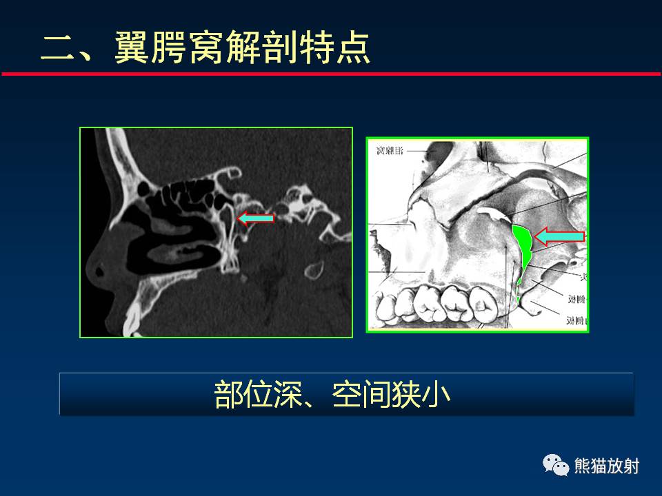 口腔翼下颌韧带照片图片