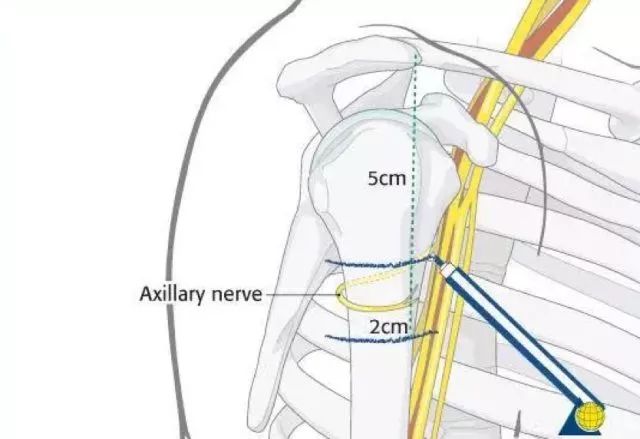 如果行微創接骨術,鋼板要在腋神經的下面通過,在第 1 條線下方 2 cm