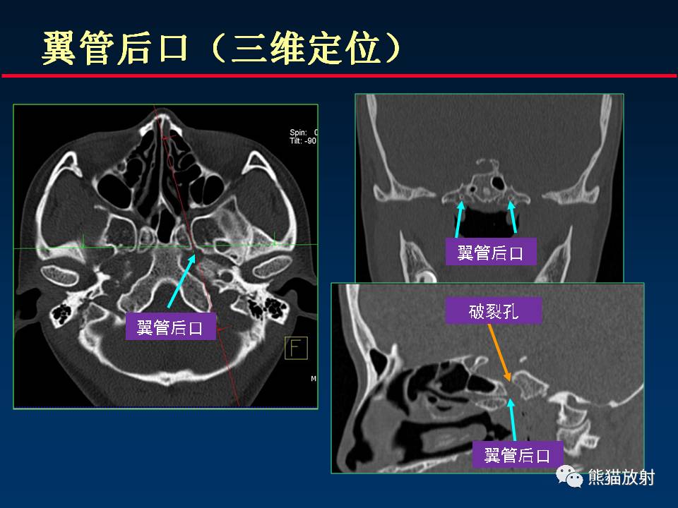 翼腭间隙图片