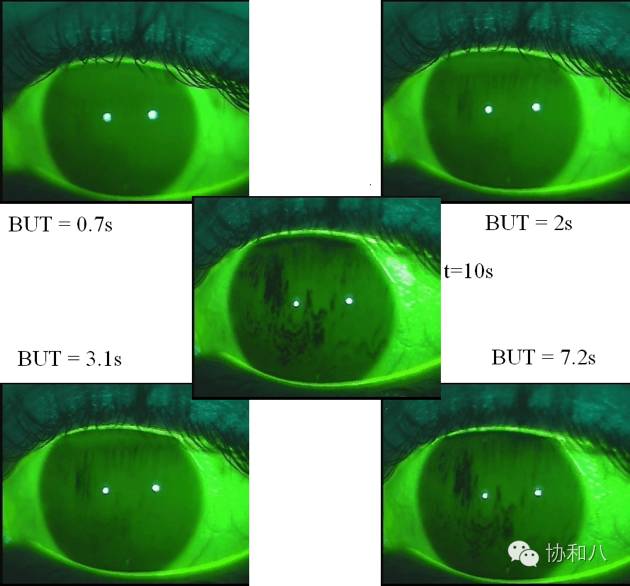 眼表活体染色此方法包括角结膜荧光素染色及虎红或丽丝胺绿染色,目前