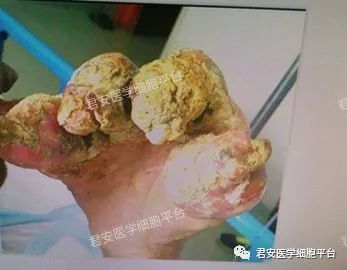 璀璨如星辰,伤人于无形之尿酸结晶