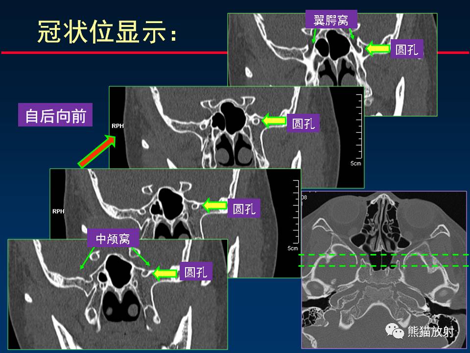 【柳澄讲坛】翼腭窝解剖