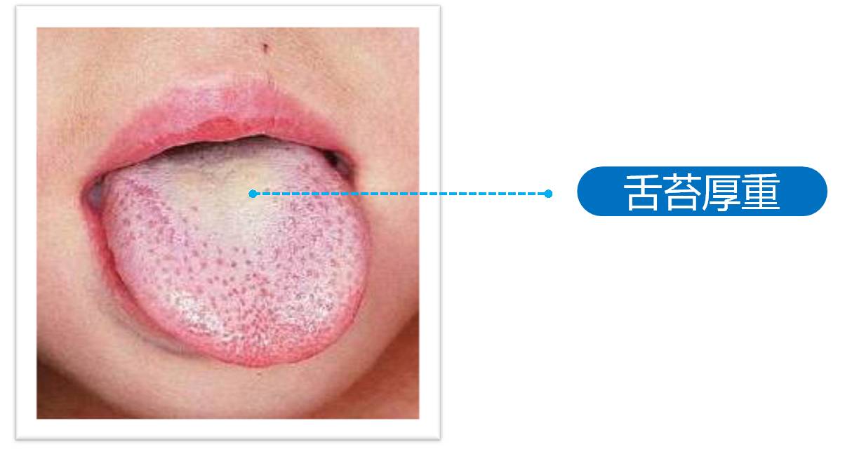 口腔来源:正如之前所说的,口臭最常见的原因就是牙周病,舌苔厚重,口腔