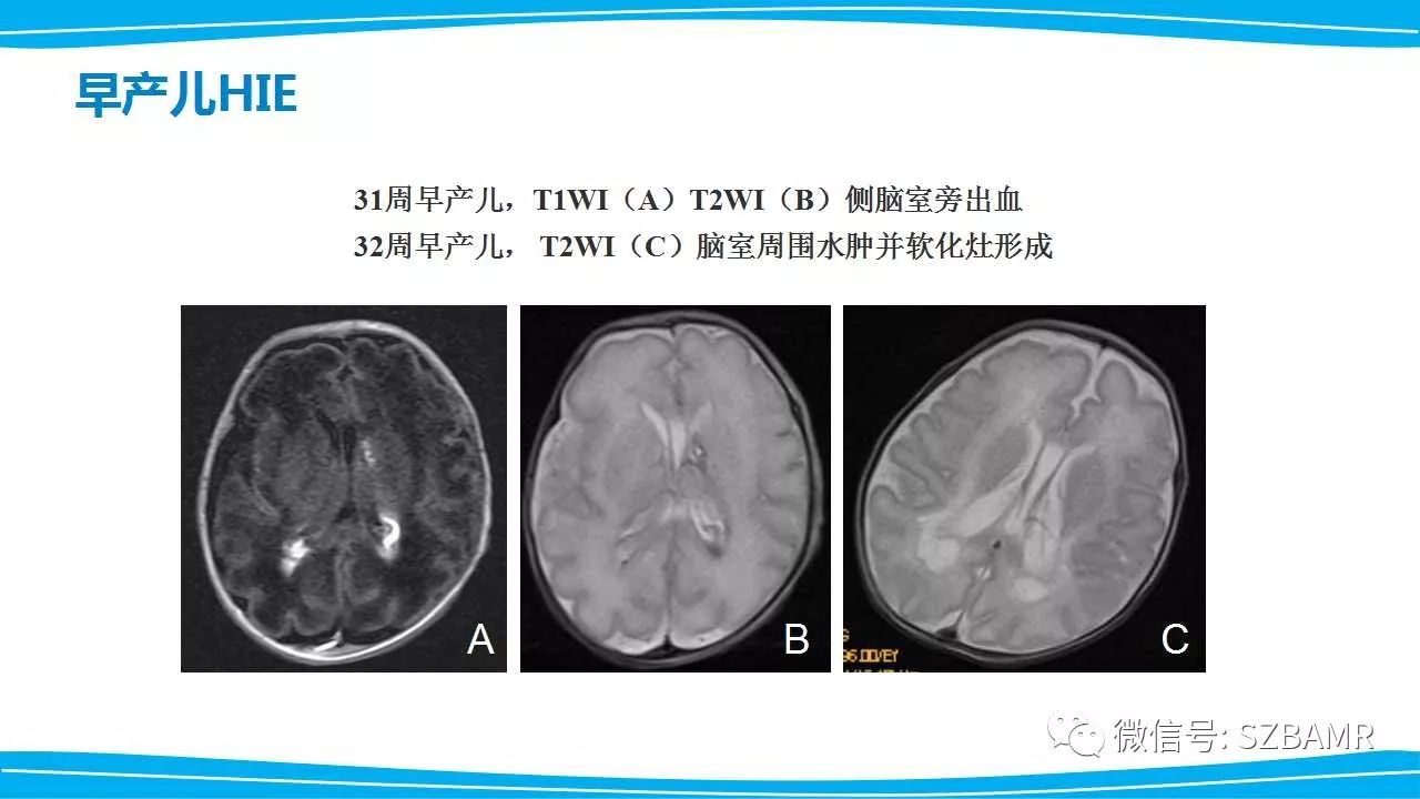 新生兒缺氧缺血性腦病hie的mri診斷