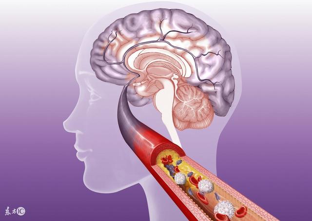 脑动脉硬化危害大改善动脉硬化学会5大要点