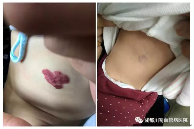 一出生腰部就長了草莓狀血管瘤10個月大小女孩的求醫之路