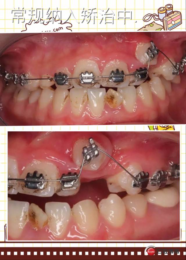 辅助弓矫治一例尖牙错位