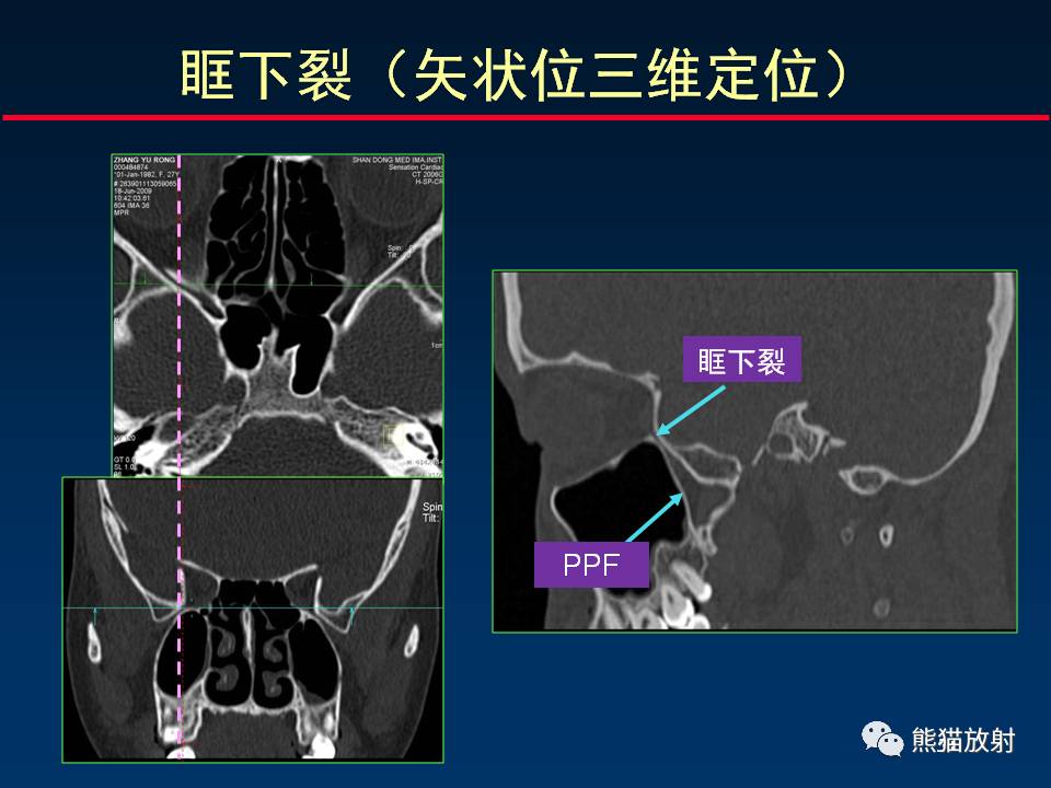 翼腭窝ct解剖图图片