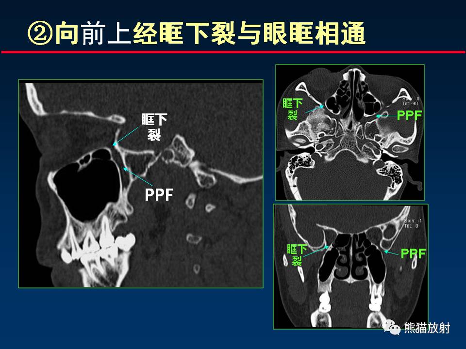 【柳澄讲坛】翼腭窝解剖