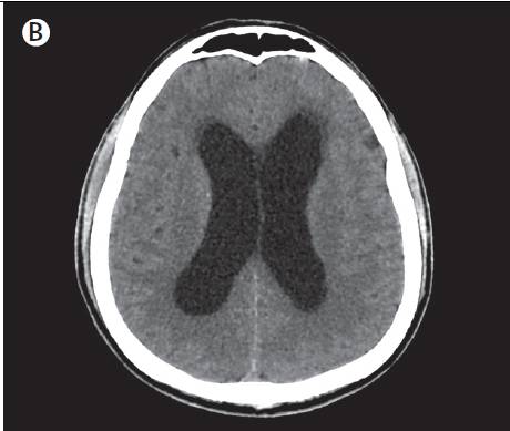 脑部ct示幕上脑室扩张(如图b)
