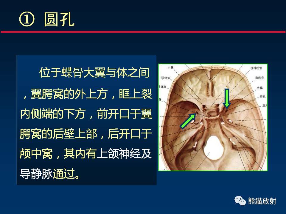 翼下颌韧带附着图片