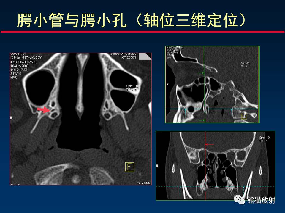 翼腭窝ct解剖图图片