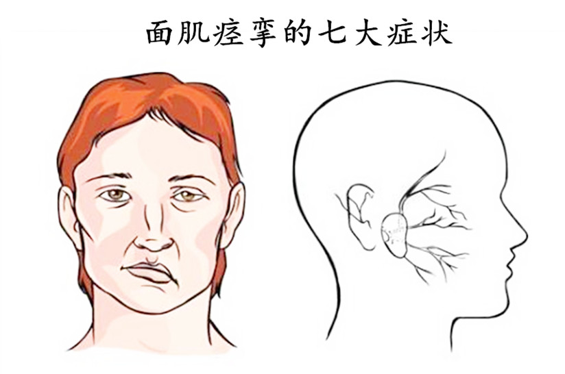面肌痉挛早期症状图片图片