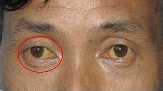 这是因为肝脏胆红素代谢的工作停下来了,患者会出现皮肤变黄,眼睛虹膜