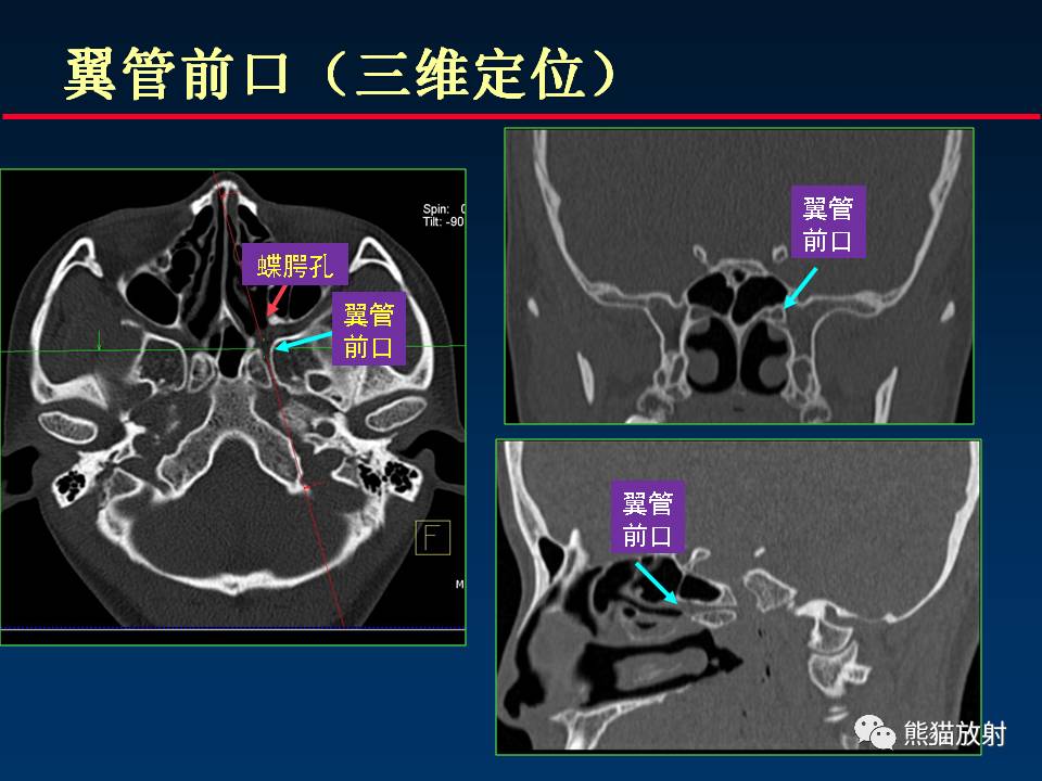 翼腭管位置图图片