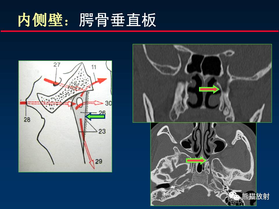 【柳澄讲坛】翼腭窝解剖