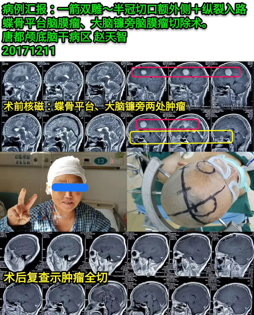 唐都腦外專家趙天智:腦腫瘤手術風險大嗎?