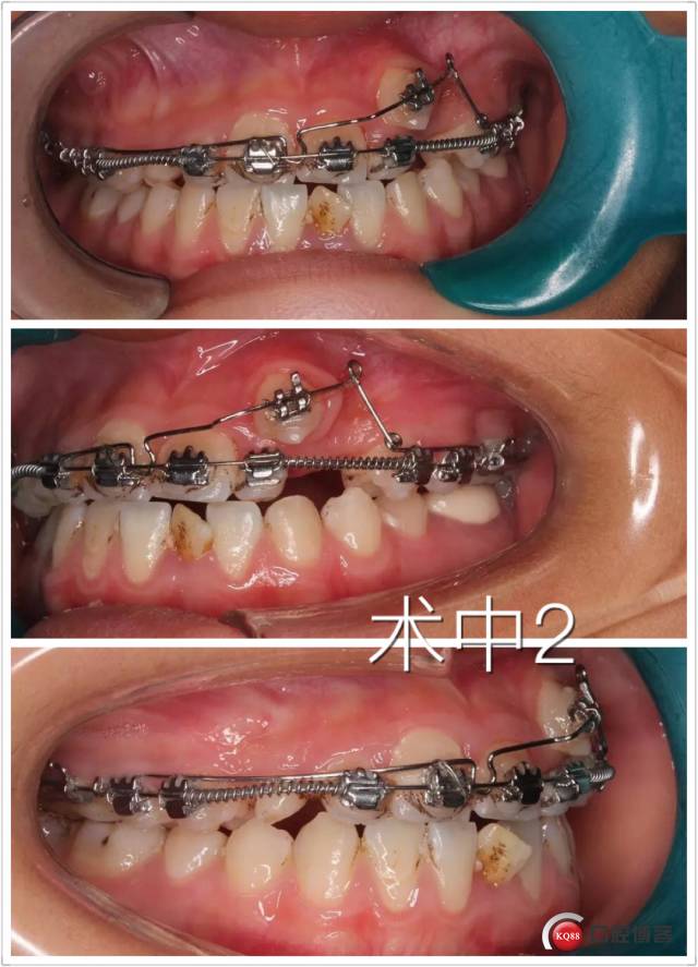 辅助弓矫治一例尖牙错位