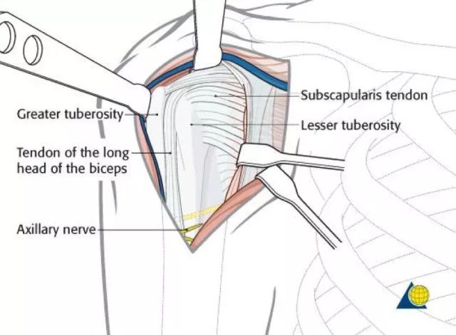 暴露肱骨近端,並確認解剖標誌(肩胛下肌腱,小結節,二頭肌腱及其間溝