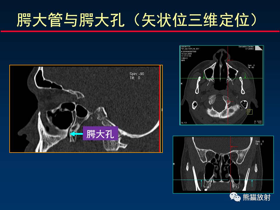 翼腭窝内动脉图片