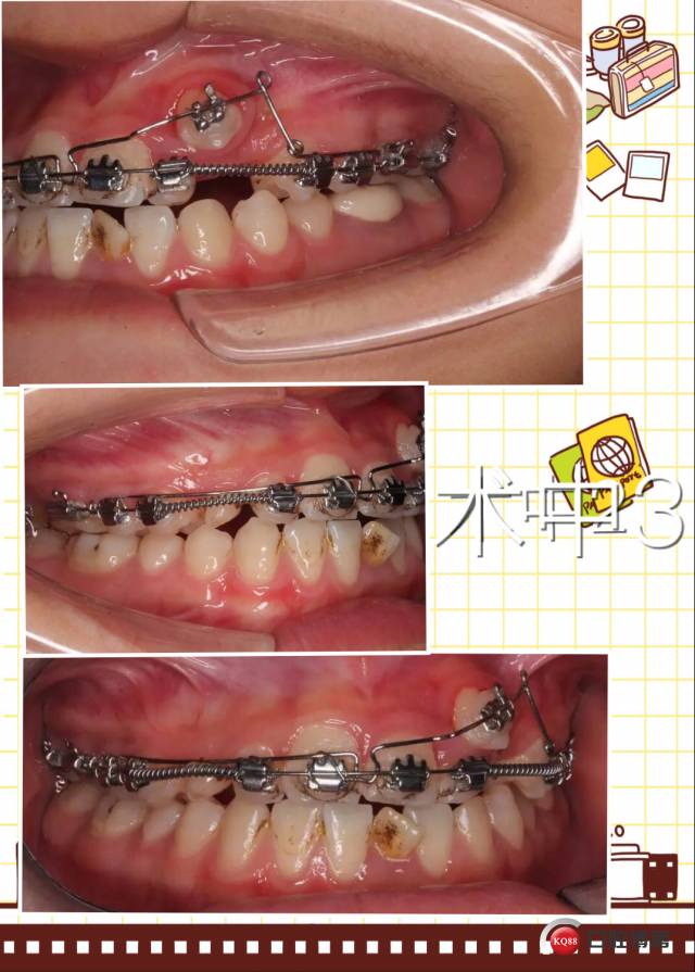 辅助弓矫治一例尖牙错位
