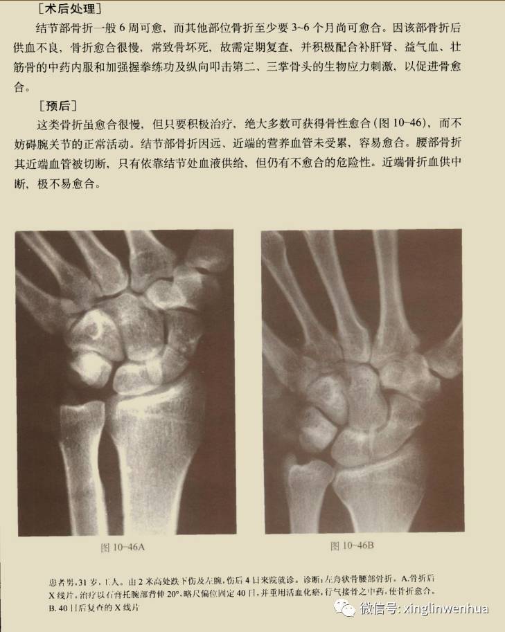 腕舟骨骨折植骨图片