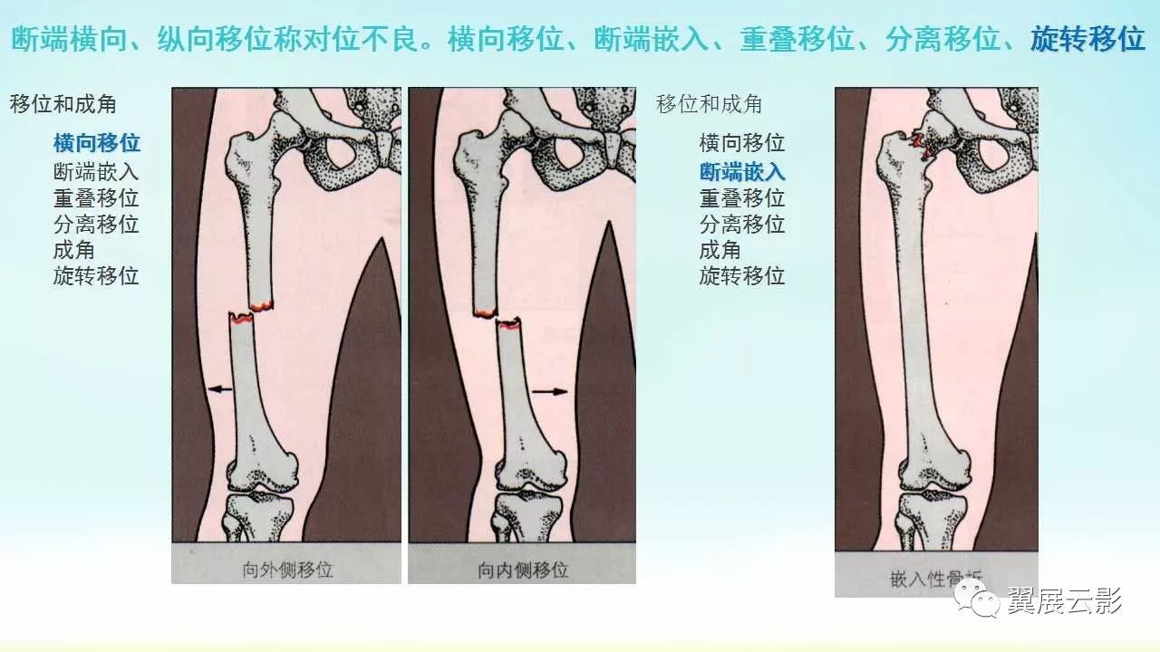 骨折成角方向示意图图片