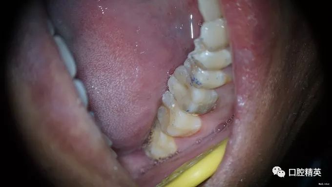 下颌第一磨牙远中3根管再治疗1例