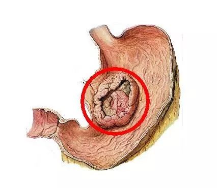 會切除多少胃?-胃癌康復圈-覓健