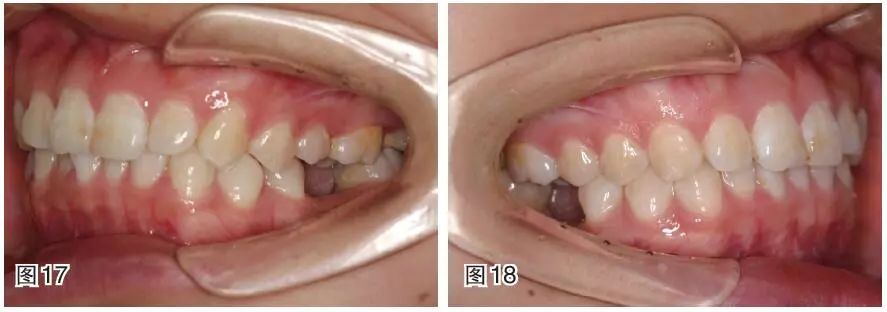 磨牙近中移动的正畸临床案例