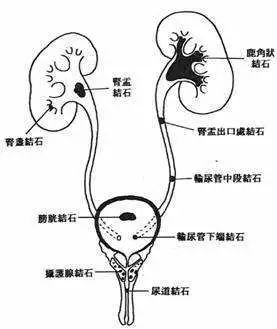 女性输尿管走形图片