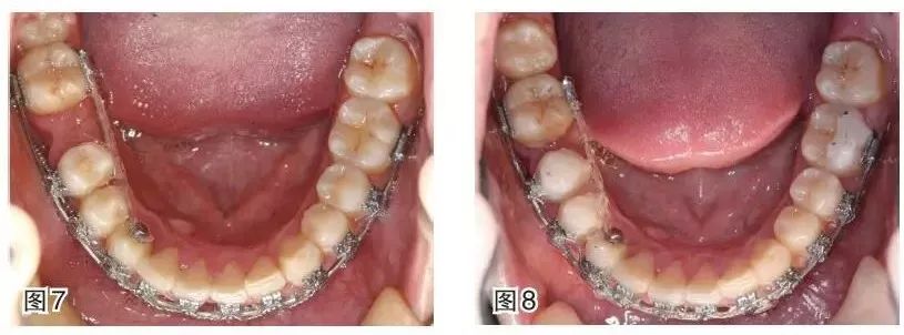 磨牙近中移動的正畸臨床案例