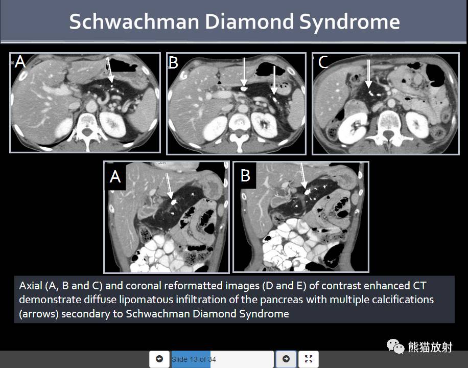 rsna精彩幻燈丨胰腺含鈣化腫物的ct診斷思路 [雙語]