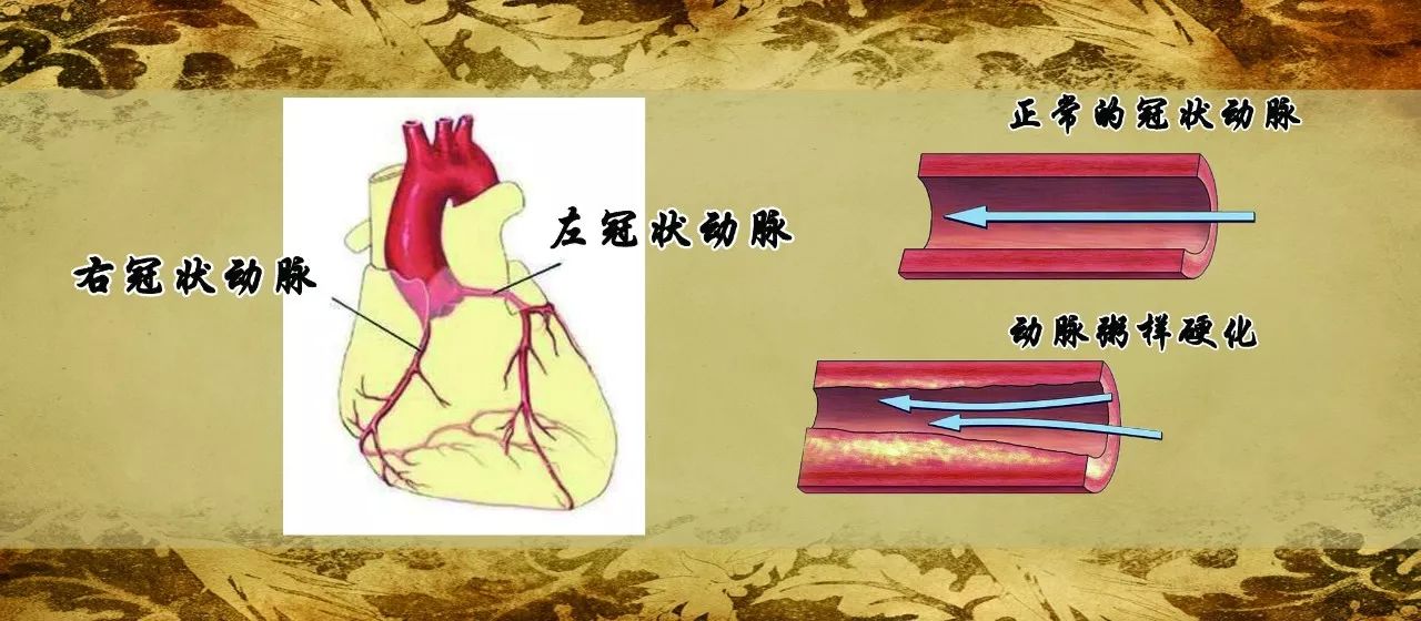中医上所说的冠心病,其核心的病机是血脉瘀阻,冠状动脉的血管被血管里