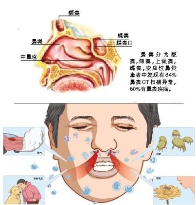 感染刺激鼻粘膜,分泌亢进,多为粘液性或粘脓性分泌物,若伴鼻窦感染,则