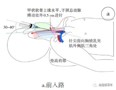 圖1 經皮頸內靜脈穿刺置管入路參考文獻【略】反正你也不看,要的話給