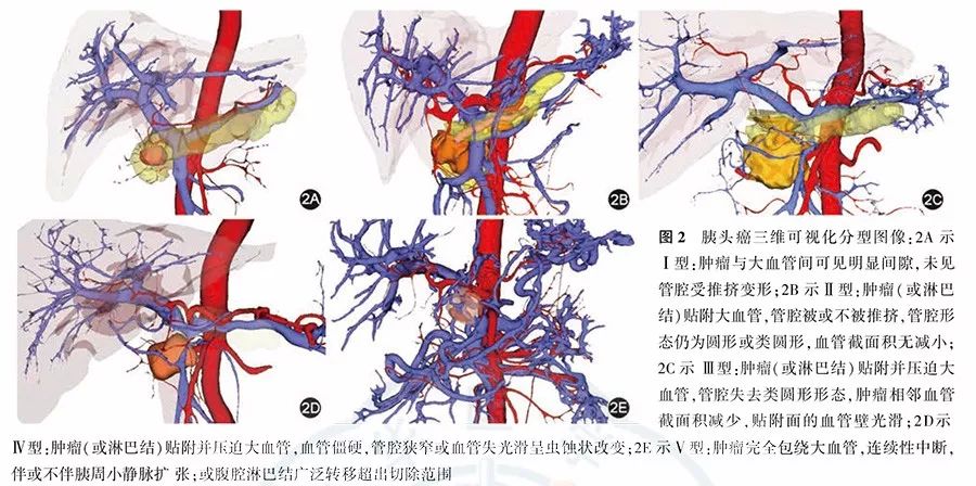 胰头癌三维可视化精准诊治专家共识