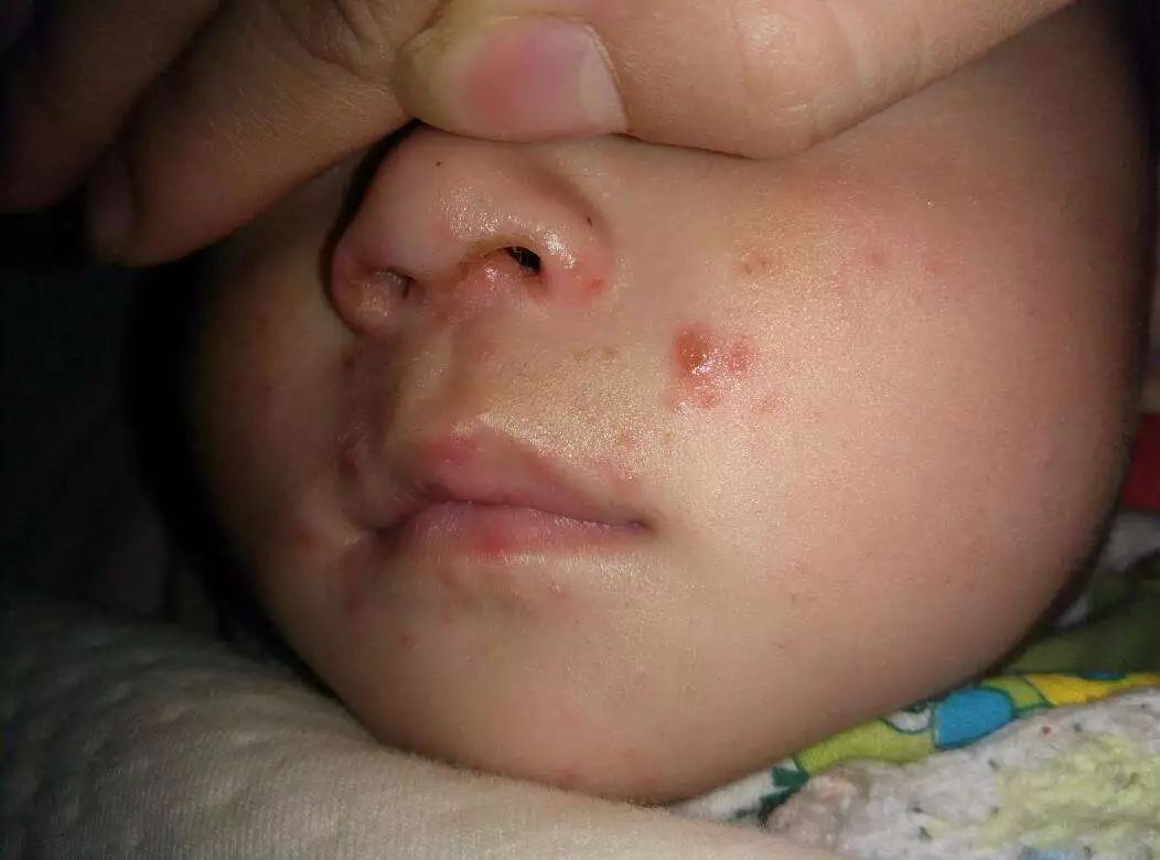 水痘初期 婴儿图片