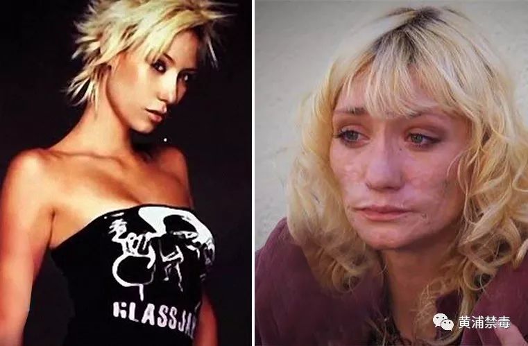禁毒案例美国小姐吸毒7年吸毒后皮肤溃烂牙齿发黄看上去老了20岁