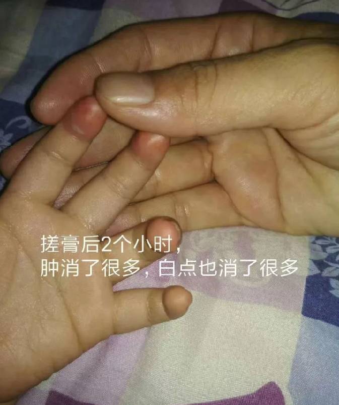 【分享】孩子三根手指夾傷用佑三一夜好轉,整個過程沒有青黑