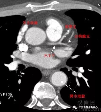心脏冠状动脉ct解剖中文详细标注图文