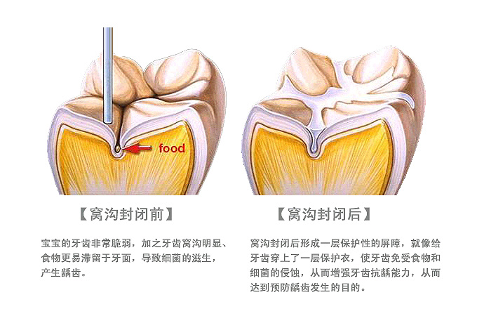 那麼什麼是窩溝封閉