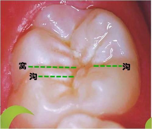 窝沟封闭疼吗图片