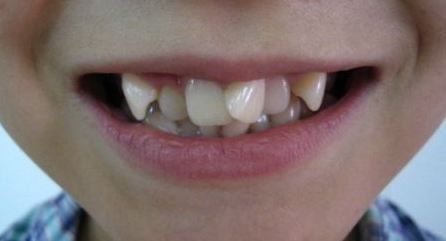 老鼠牙老鼠牙,又叫做过小牙,一般长在门牙旁边,又细又小,美观度低