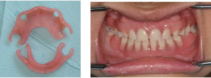 图6 (病例4)患儿9岁,先天多数牙缺失,基牙锥形,没有固位倒凹,采用弹性