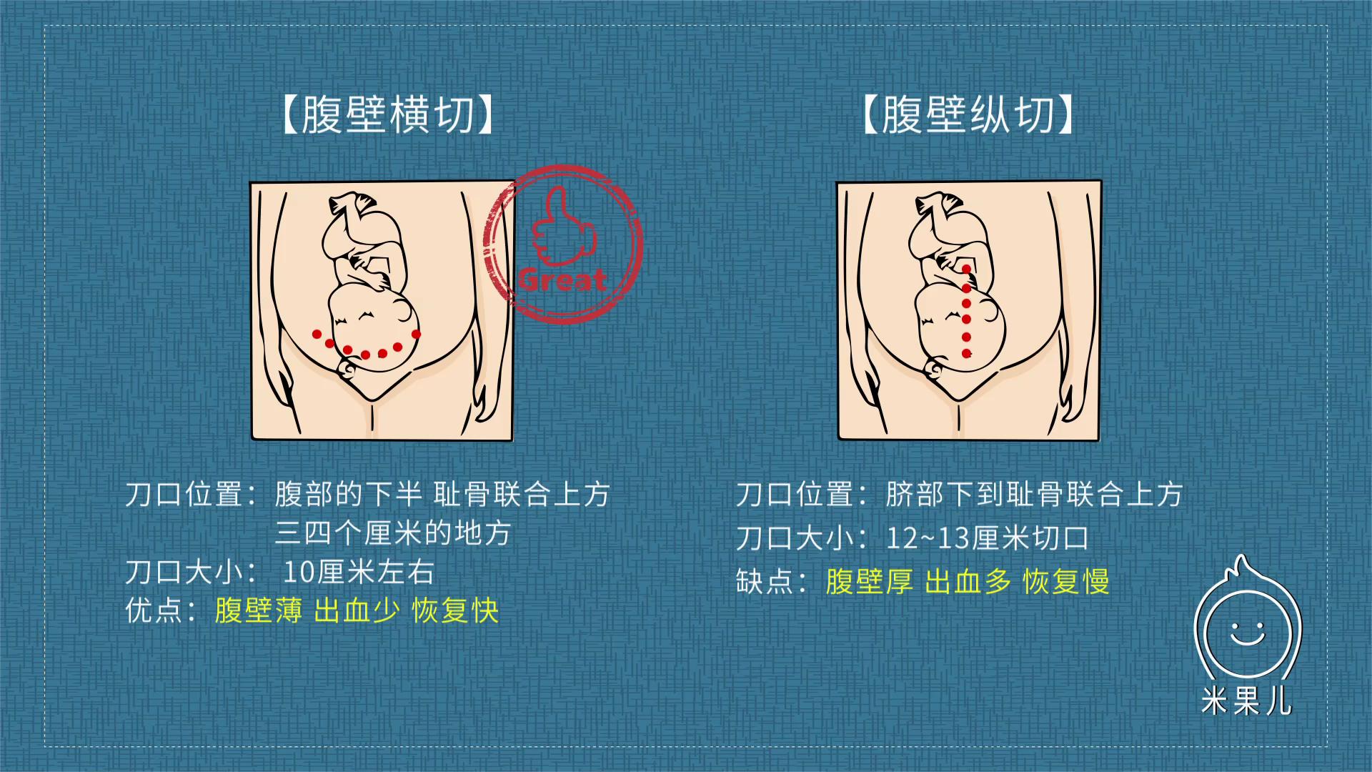 剖宫产图解图片