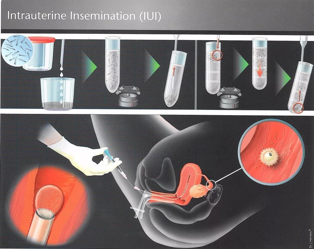 人工授精(iui,就是在排卵期将处理后的丈夫精子注入女性子宫腔内的